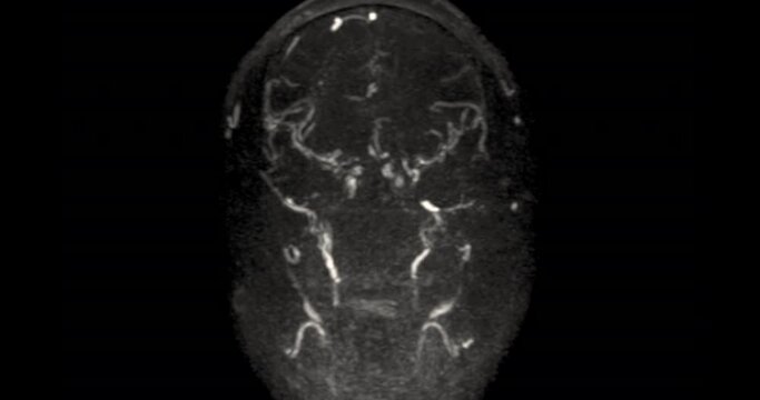 MR cerebral venography (MRV) or MRV Brain for diagnostic Cerebral venous thrombosis (blood clots in the brain) and 
Structural vein abnormalities.