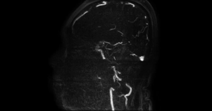 MR cerebral venography (MRV) or MRV Brain for diagnostic Cerebral venous thrombosis (blood clots in the brain) and 
Structural vein abnormalities.