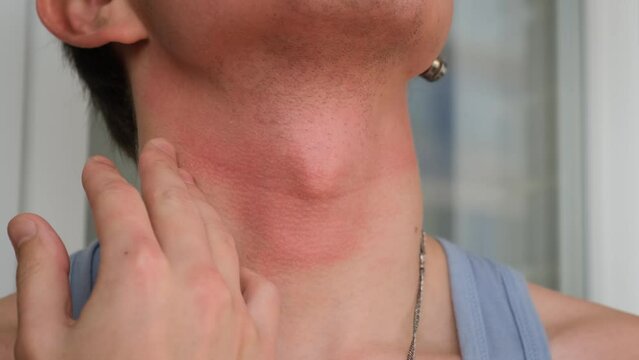 Allergy and redness on the skin of the neck of a man, close-up. Dermatitis