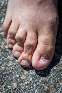 Looking down at a man's foot that is missing the big toe nail