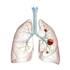 Lung cancer or carcinoma 3D rendering illustration. Bronchial tree and lungs infected by cancer cells on white background. Medical, healthcare, oncology, disease, science concept. - obrazy, fototapety, plakaty