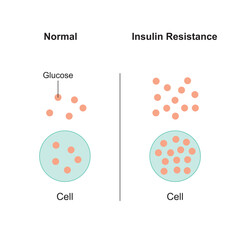 Insulin Resistance Concept Design. Vector Illustration.