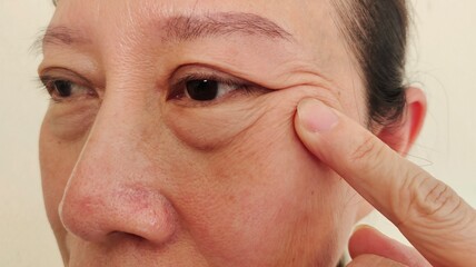 Portrait the fingers holding the flabbiness and wrinkles on the cheek, ptosis and flabby skin...