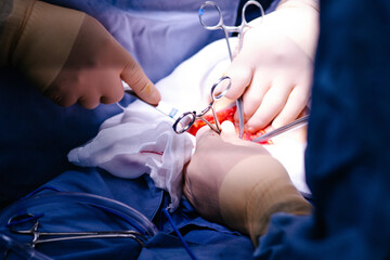 Doctores interviniendo madre durante cesárea 