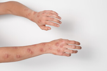 Woman with rash suffering from monkeypox virus on white background, closeup