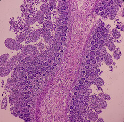Intra abdominal mass with transverse colon(biopsy): Fibromatosis. Nodular mass show spindle cells with bland nuclei, collagen, elongated vessels and infiltration of inflammatory cells.