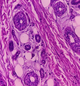 Finger biopsy, finger cancer, Invasive squamous cell carcinoma, grade-II. Show malignant neoplasm of atypical squamous epithelial cells.