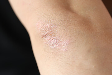 Psoriatic plaques on elbow of patient with skin disease closeup