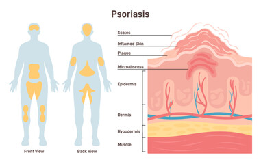 Psoriasis. Autoimmune disease characterized by areas of inflamed skin