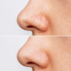 Profile of woman's nose with blackheads before and after peeling and cleansing the face. Acne...