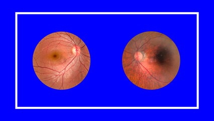 View inside human eye disorders - showing retina, optic nerve and macula.Retinal picture ,Medical...