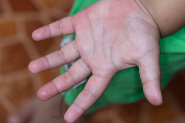 It is a dermatitis small warty bumps appear on the skin in child.