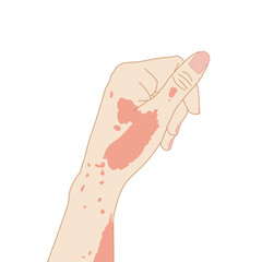 Allergy rash or urticaria on hand, flat illustration on white background