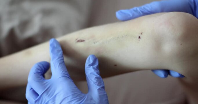 Wound is scratch with blood on lower leg and doctor heals