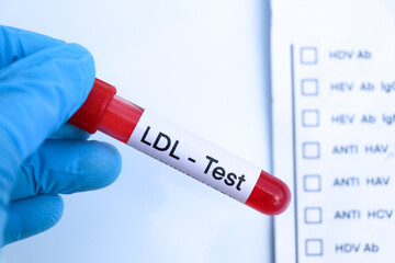 Obraz premium LDL test to look for abnormalities from blood