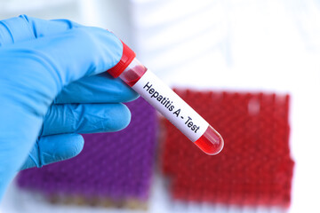 Obraz premium Hepatitis A test to look for abnormalities from blood