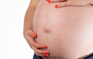 Stretch marks on the abdomen of a pregnant girl, a bulging navel. Cosmetic defect on the skin...