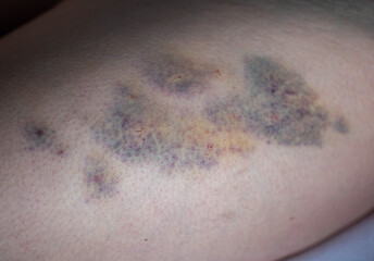 Bruises on the skin of the patient's leg after intramuscular injections of the drug. Treatment of seals and bruises after injections.