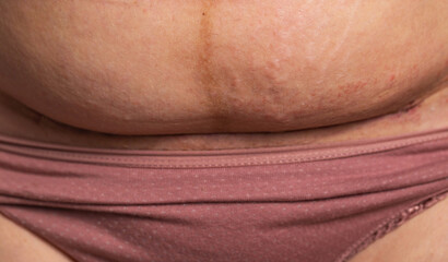 The seam on the abdomen of a woman after a caesarean section. Recovery of the female body after the birth of a child, complications. Close-up, postponed