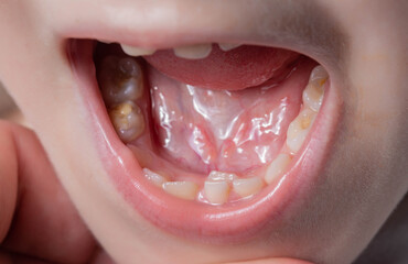 A permanent molar in a child grows second row. Incorrect growth of molars or polyodontia in...