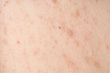 Fototapeta premium Skin with acne, with red spots. Health problem, skin diseases. Close up Allergy rash. Dermatitis problem of rash. 
