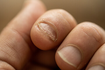 Onychophagy. Close up of fingers with eaten nail. Effects of anxiety and nerves.