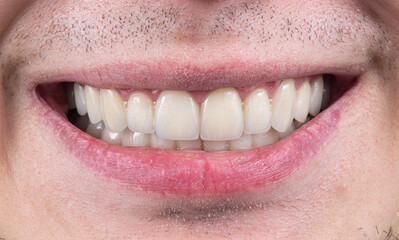 ceramic crowns and veneers