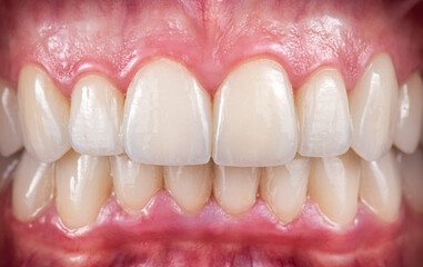 ceramic crowns and veneers
