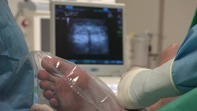 Varicose veins are veins that have become enlarged and twisted.The term commonly refers to the veins on the leg, although varicose veins can occur elsewhere.