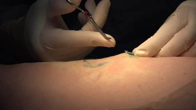 Varicose veins are veins that have become enlarged and twisted.The term commonly refers to the veins on the leg, although varicose veins can occur elsewhere.