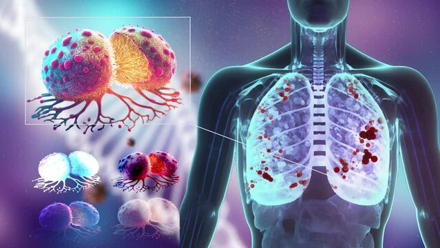 Lung Cancer concept with human body X-ray revealing lungs and cancer cells with DNA background 3d rendering