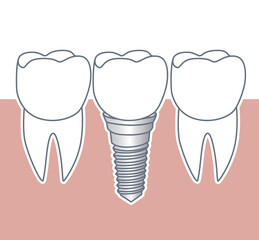 Dental implant screw and abutment for human healthy root, illustration on white background