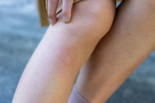 Woman Sit On The Bench At Park With Suffers From Mosquito Bite