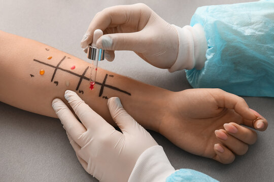 Doctor with dropper making allergy skin test on patient's hand in clinic, closeup