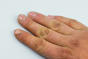 Broken hands of a construction worker. Nails in poor condition.Damaged and hard skin