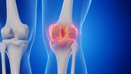 3d rendered medical illustration of a man's knee - obrazy, fototapety, plakaty