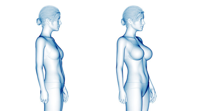 3d rendered medical illustration of a woman after breast enlargement surgery