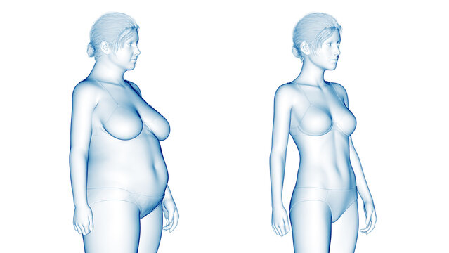3d rendered medical illustration of an overweight woman's weight loss