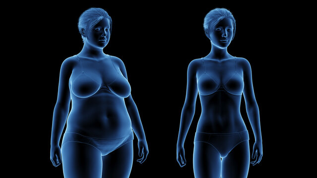 3d rendered medical illustration of an overweight woman's weight loss