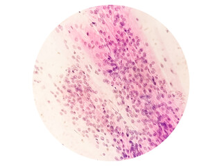 Microscopic view of Trichomonas vaginalis in pap smear with few acute inflammatory cells. Cytology and pathology laboratory department. Sexually transmitted disease. Trichomoniasis