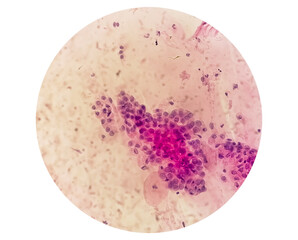 Microscopic view of Trichomonas vaginalis in pap smear with few acute inflammatory cells. Cytology and pathology laboratory department. Sexually transmitted disease. Trichomoniasis