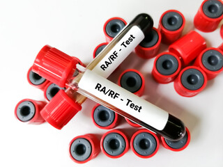 Blood sample RF (Rheumatoid factor) or RA (Rheumatoid arthritis) test, diagnosis for rheumatoid...