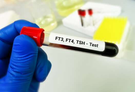 Blood sample in test tube for hormonal examination of thyroid gland in laboratory. FT3, FT4, TSH. Diagnosis of hyperthyroidism or hypothyroidism of a patient
