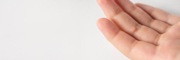 Wart on the finger. Close-up of a wart on a child's finger. The common wart Verruca vulgaris is...