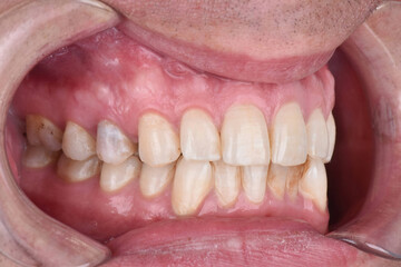 Close up side view teeth picture fixator dental examination before treatment