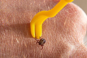 Removing a stuck tick from human skin. macro photography.