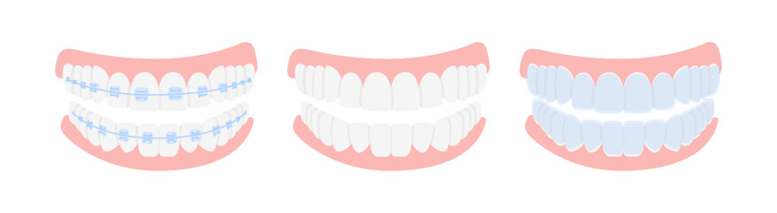 Braces, mouthguards, and aligners for correction jaw and teeth, isolated on white background. Concept dental medecine, stomatology. Cartoon flat design. Vector illustration.