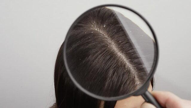 Female hair with dandruff under a magnifying glass