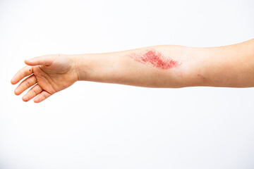 Children's hand burn. Children's hand with a burnt wound on a white background.Close up
