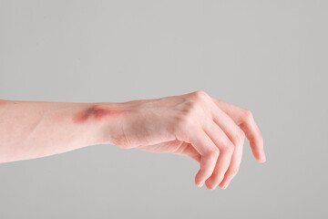 Fototapeta na wymiar Bruised female hand on grey background